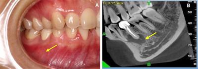 Case Report: Application of Mixed Reality Combined With A Surgical Template for Precise Periapical Surgery